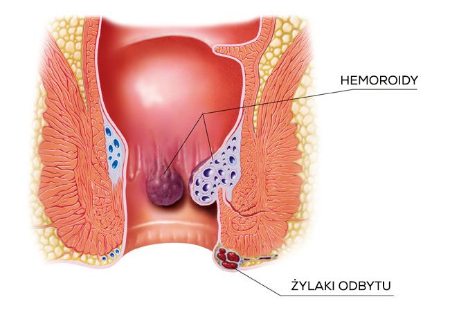 Hemorrhoids - the mechanism of formation