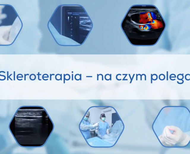 Skleroterapia - na czym polega?