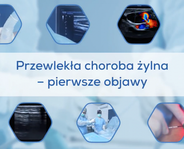 Przewlekła choroba żylna - pierwsze objawy