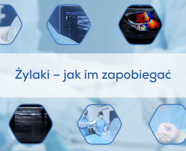 Żylaki - jak im zapobiegać?