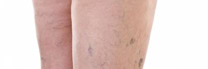 Venous insufficiency of lower limbs