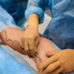 Zabieg miniflebektomii w Klinice Flebologii Warszawa - chirurg flebolog wykonujący mało inwazyjne usuwanie żylaków przez drobne nacięcia.