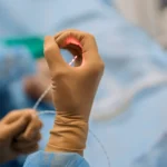 Zabieg laserowy hemoroidów proktologia - miniinwazyjne leczenie hemoroidów włóknem laserowym - nowoczesna procedura bez bólu w Klinice Flebologii - Puławska 17, Warszawa.