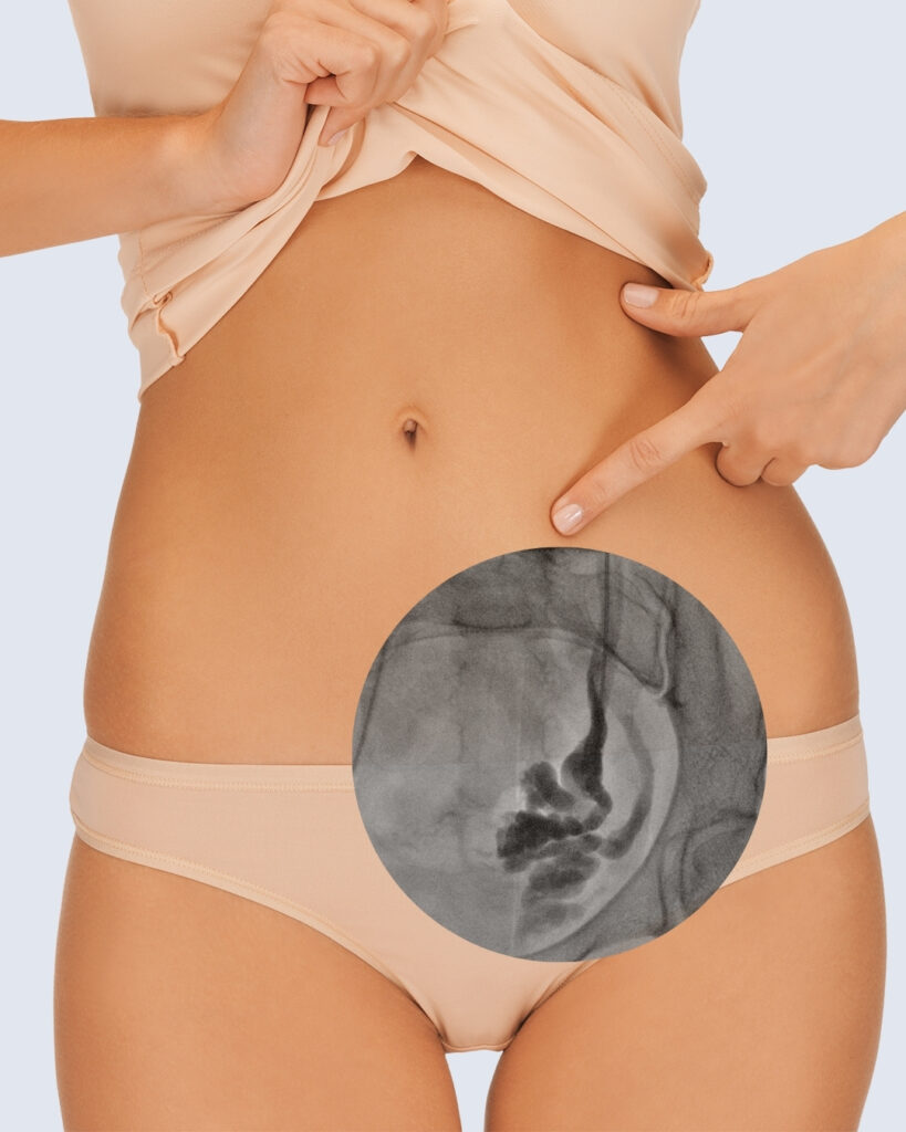 Kobieta wskazuje pole bolesne na ciele w rzucie niewydolnej lewej żyły jajnikowej (żyła miłości).