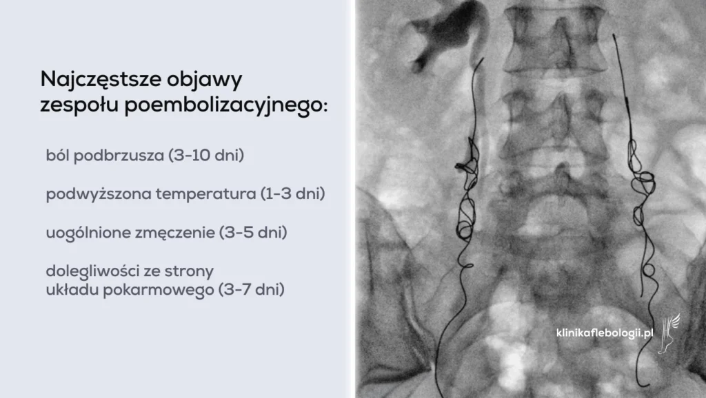 Obraz z zabiegu embolizacji żylnej 2-stronnej (zembolizowane dwie żyły jajnikowe przy uzyciu coili). Obok lista najczęstszych objawów zespołu embolizacyjnego wg danych Kliniki Flebologii.