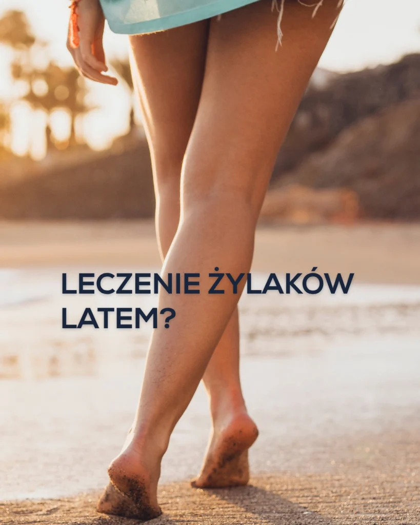 Pacjentka po zabiegu laserowego usuwania żylaków cieszy się latem bez bólu i dyskomfortu.